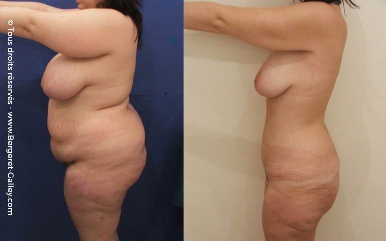 Abdominoplastie, cas 1, photographie avant et après