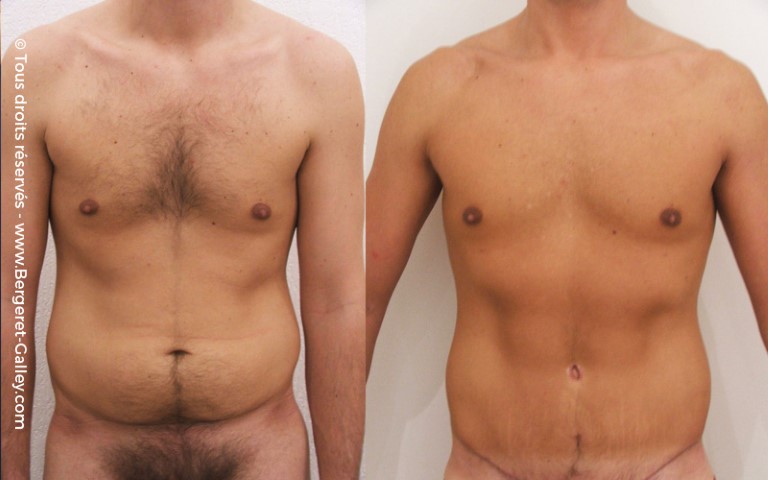 Abdominoplastie, cas 2, photographie avant et après