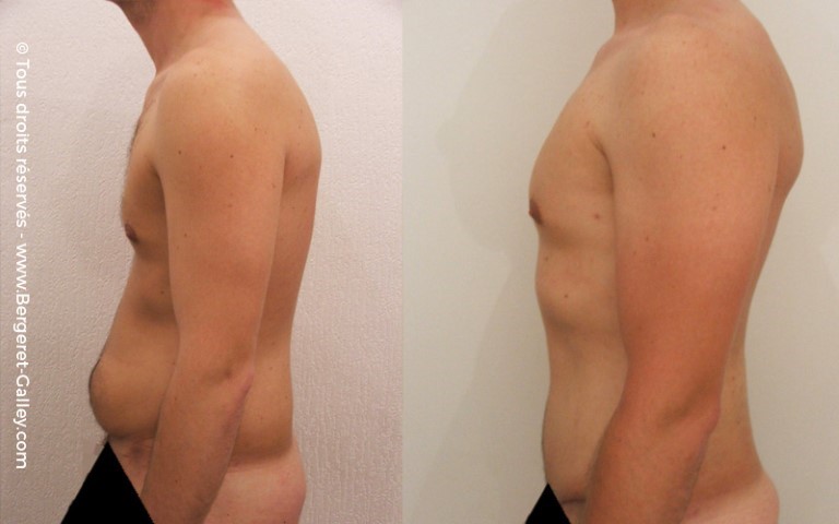 Abdominoplastie, cas 3, photographie avant et après