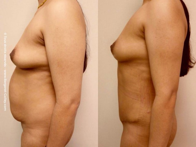 Abdominoplastie, cas 5, photographie avant et après