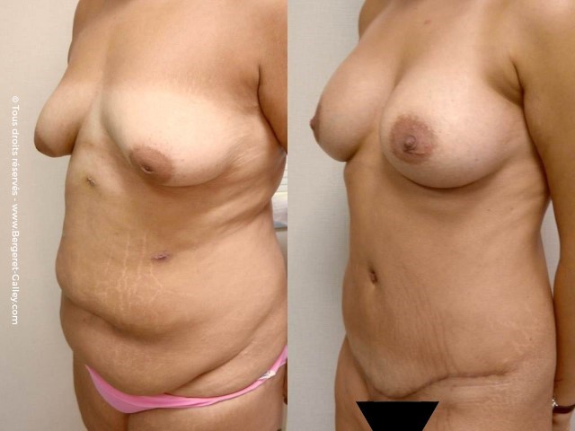 Abdominoplastie, cas 6, photographie avant et après