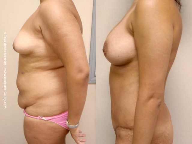 Abdominoplastie, cas 7, photographie avant et après