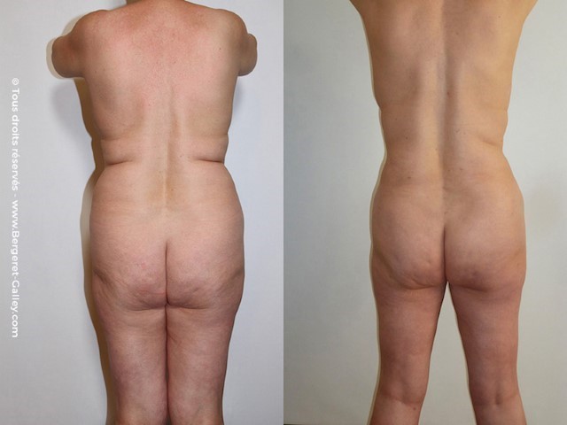 Abdominoplastie, cas 9, photographie avant et après