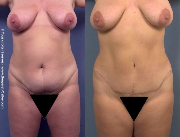 Abdominoplastie, cas 10, photographie avant et après