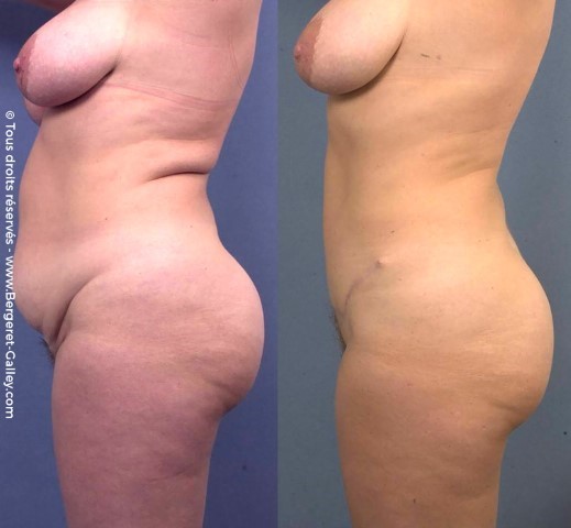 Abdominoplastie, cas 11, photographie avant et après