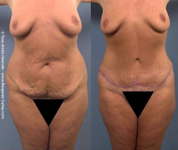 Abdominoplastie, cas 12, photographie avant et après