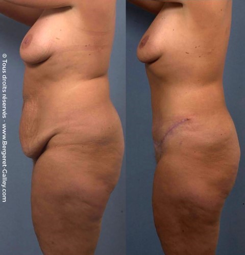 Abdominoplastie, cas 13, photographie avant et après