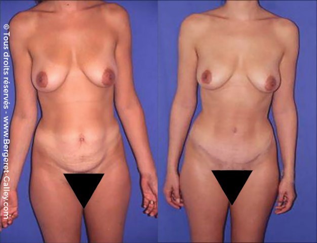 Abdominoplastie, cas 14, photographie avant et après