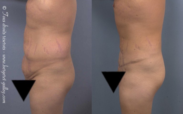 Abdominoplastie, cas 15, photographie avant et après