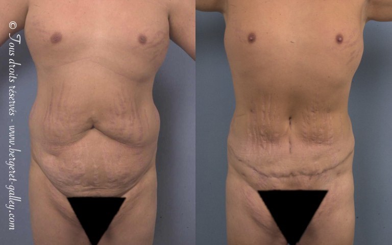 Abdominoplastie, cas 16, photographie avant et après