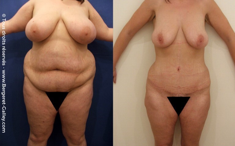 Abdominoplastie, cas 17, photographie avant et après