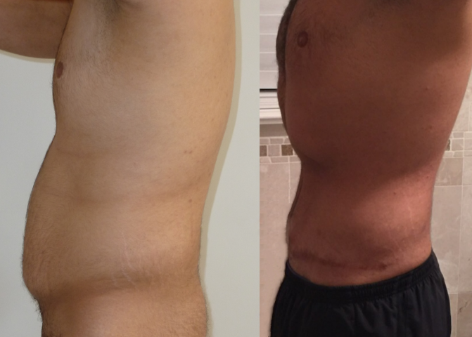 Abdominoplastie, cas 18, photographie avant et après