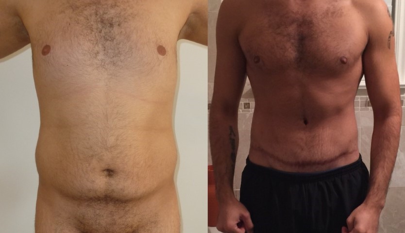 Abdominoplastie, cas 19, photographie avant et après