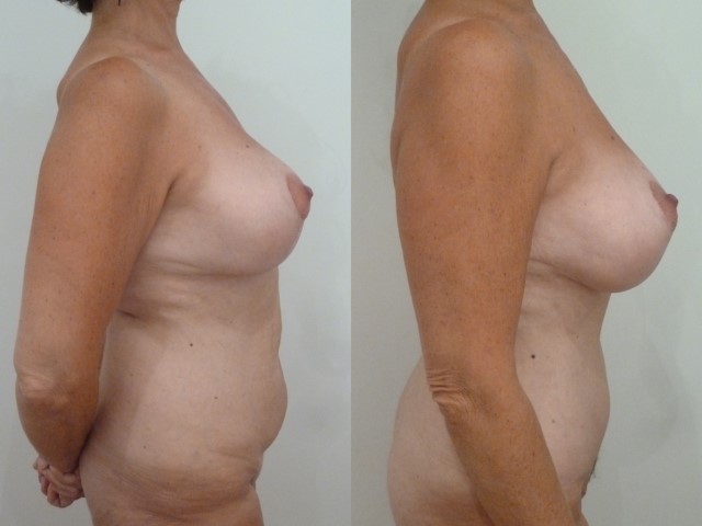 Abdominoplastie, cas 21, photographie avant et après