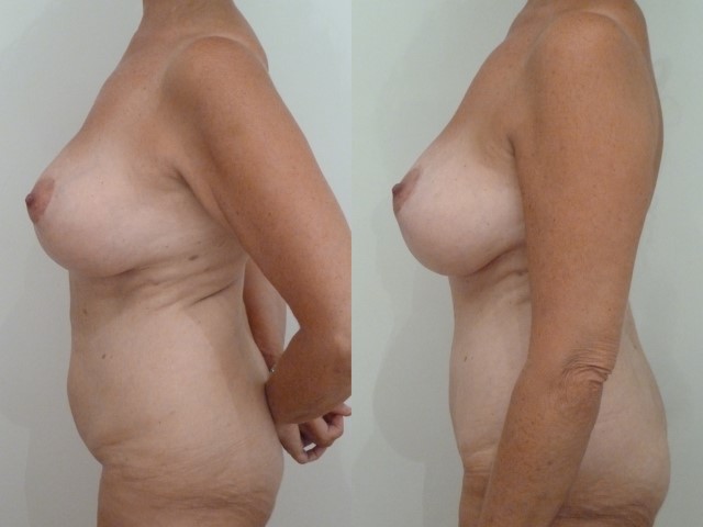 Abdominoplastie, cas 22, photographie avant et après