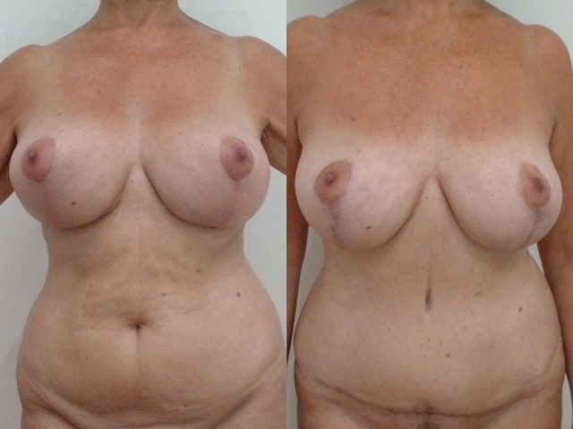 Abdominoplastie, cas 23, photographie avant et après
