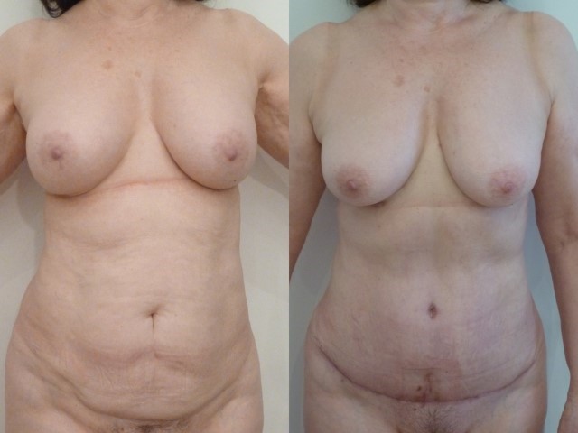 Abdominoplastie, cas 28, photographie avant et après