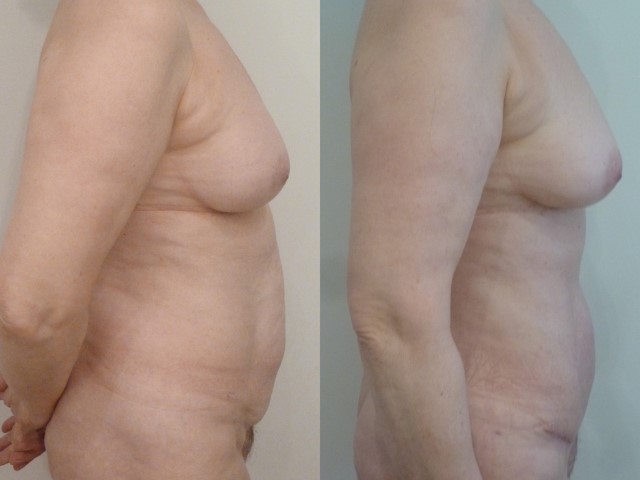 Abdominoplastie, cas 29, photographie avant et après