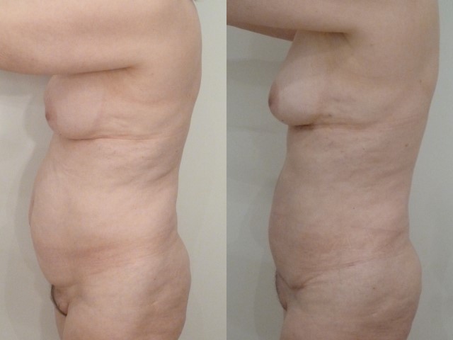 Abdominoplastie, cas 30, photographie avant et après