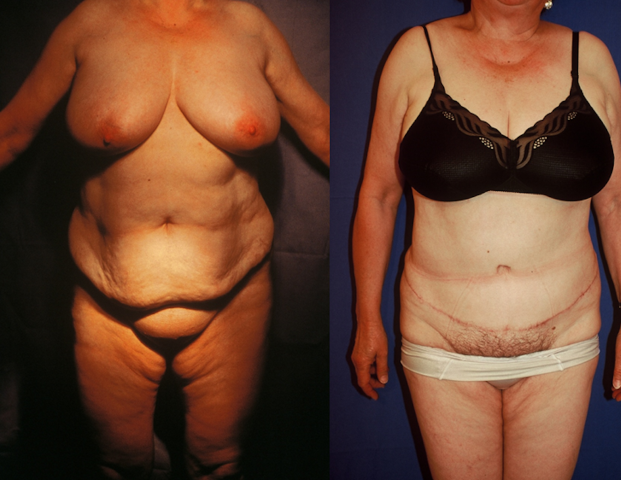 Abdominoplastie, cas 31, photographie avant et après