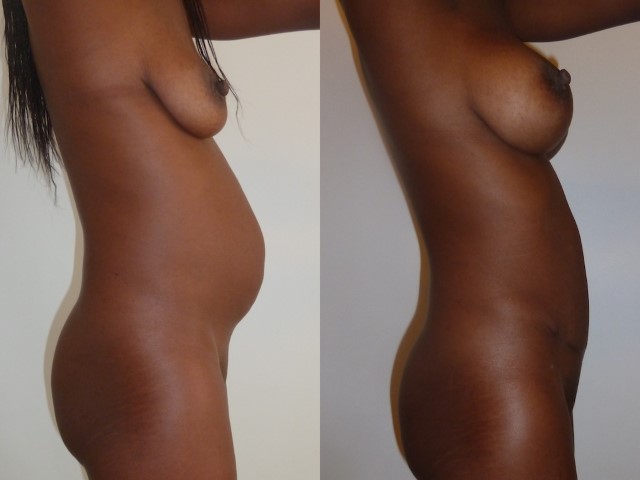 Abdominoplastie, cas 34, photographie avant et après