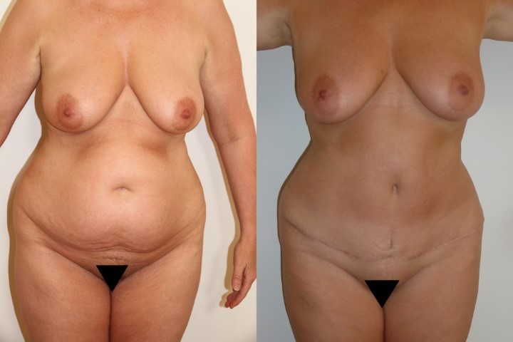 Abdominoplastie, cas 35, photographie avant et après