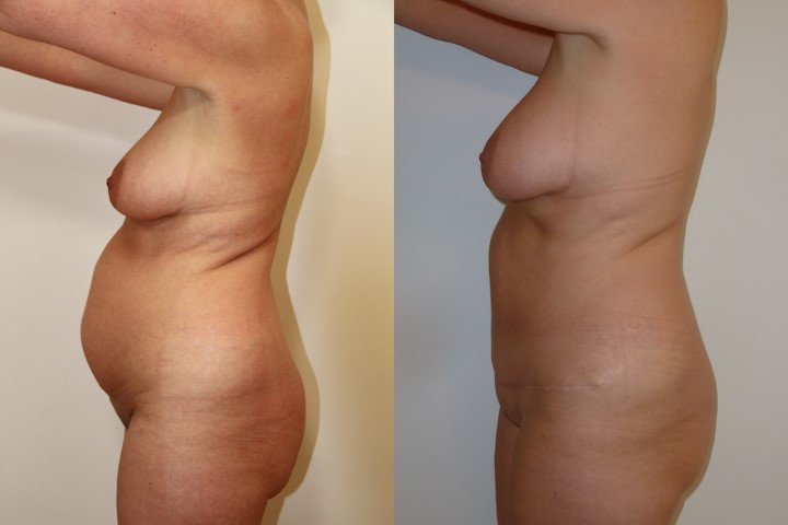Abdominoplastie, cas 36, photographie avant et après