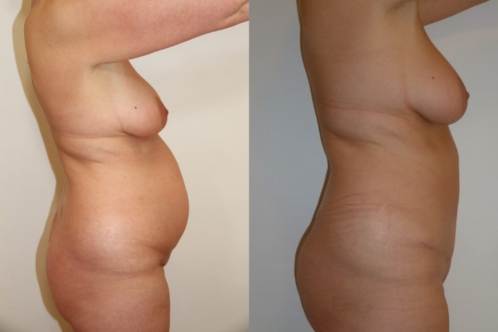 Abdominoplastie, cas 37, photographie avant et après