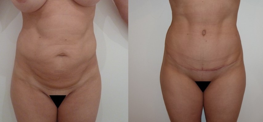 Abdominoplastie, cas 38, photographie avant et après