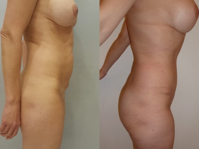 Abdominoplastie, cas 39, photographie avant et après
