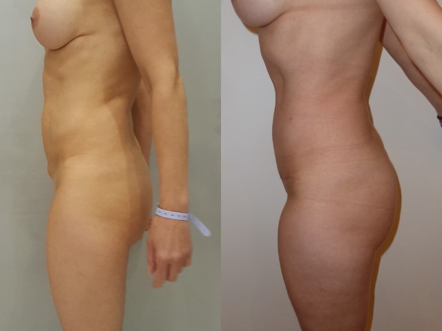 Abdominoplastie, cas 40, photographie avant et après