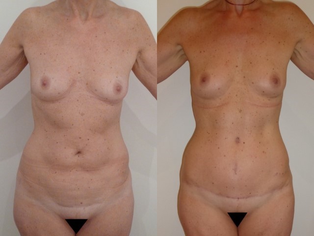 Abdominoplastie, cas 41, photographie avant et après