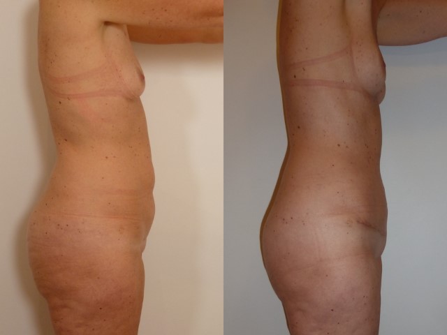 Abdominoplastie, cas 42, photographie avant et après