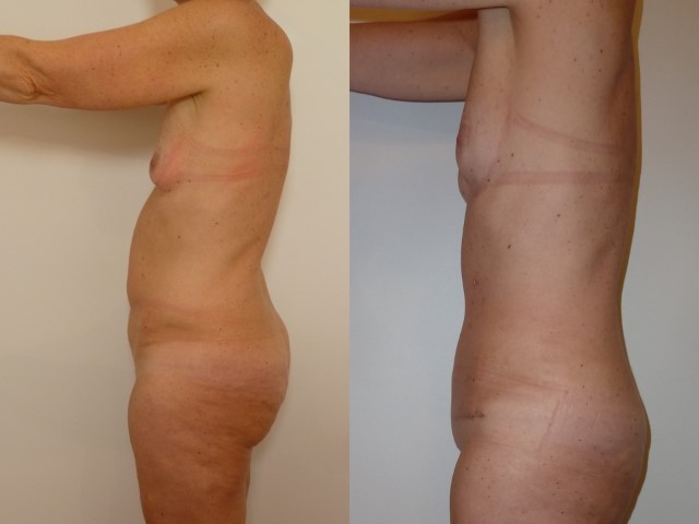 Abdominoplastie, cas 43, photographie avant et après