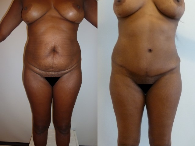 Abdominoplastie, cas 44, photographie avant et après