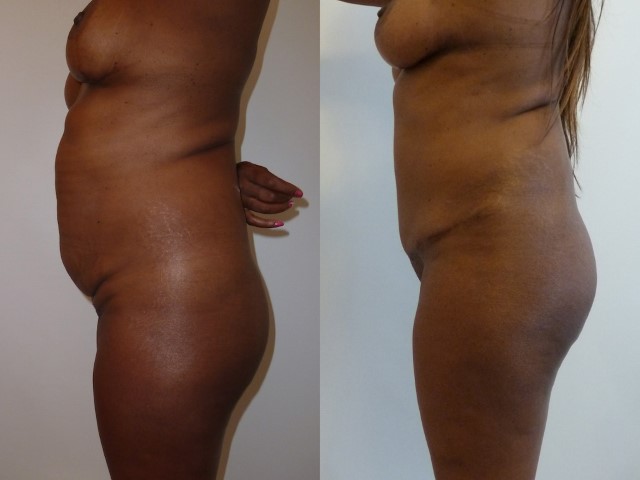 Abdominoplastie, cas 45, photographie avant et après