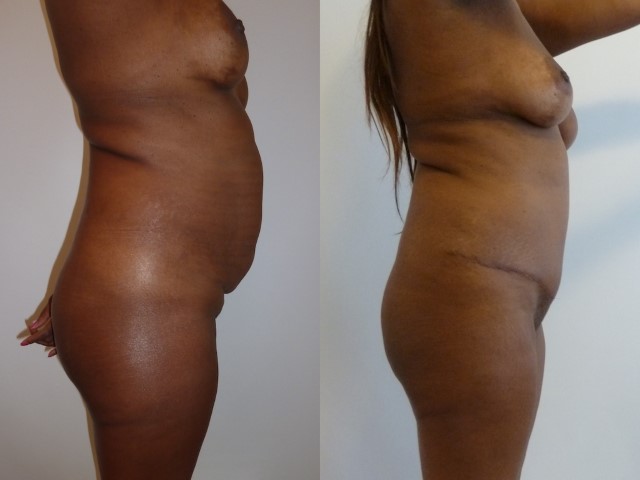 Abdominoplastie, cas 46, photographie avant et après