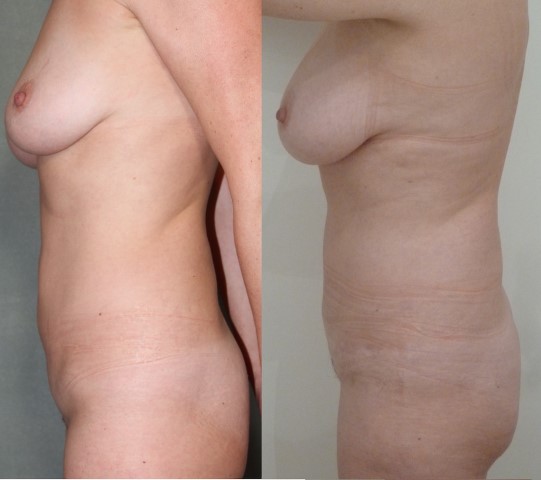 Abdominoplastie, cas 47, photographie avant et après