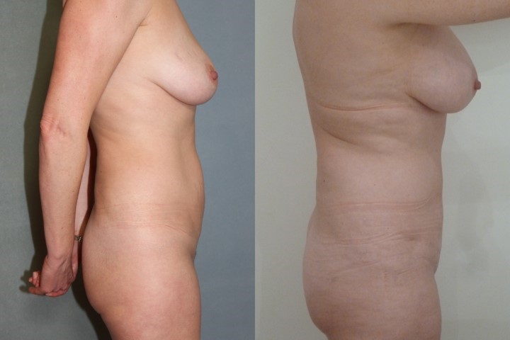 Abdominoplastie, cas 48, photographie avant et après