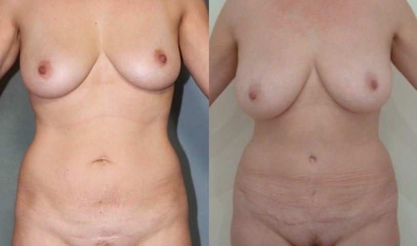 Abdominoplastie, cas 49, photographie avant et après
