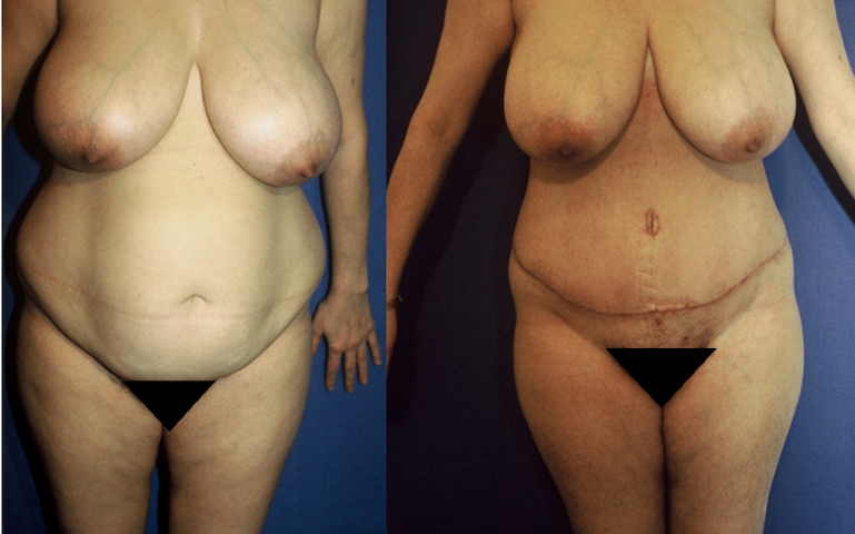 Abdominoplastie, cas 50, photographie avant et après