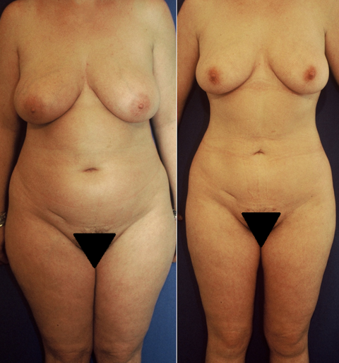 Abdominoplastie, cas 51, photographie avant et après