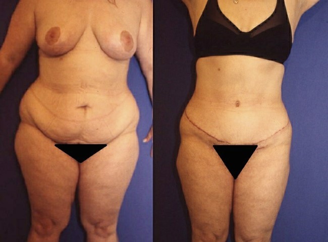 Abdominoplastie, cas 52, photographie avant et après