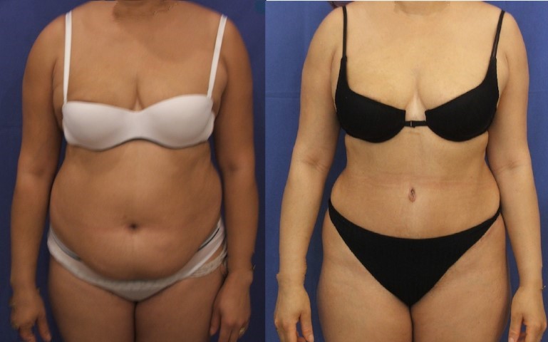 Abdominoplastie, cas 53, photographie avant et après