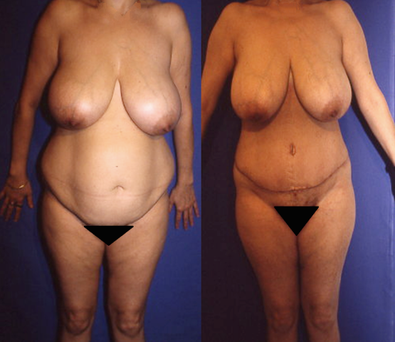 Abdominoplastie, cas 54, photographie avant et après
