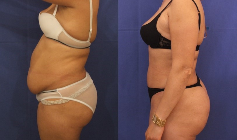 Abdominoplastie, cas 55, photographie avant et après