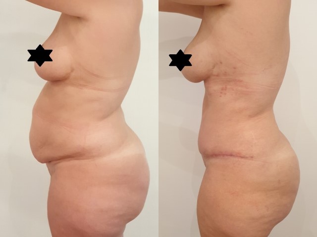 Abdominoplastie, cas 56, photographie avant et après