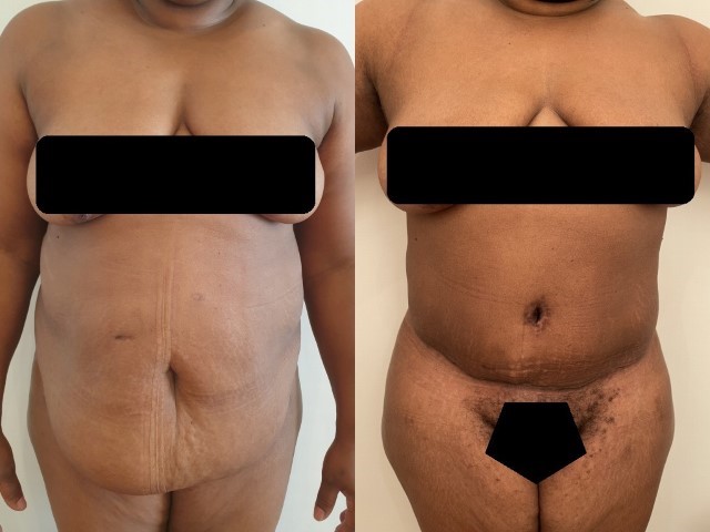 Abdominoplastie, cas 58, photographie avant et après