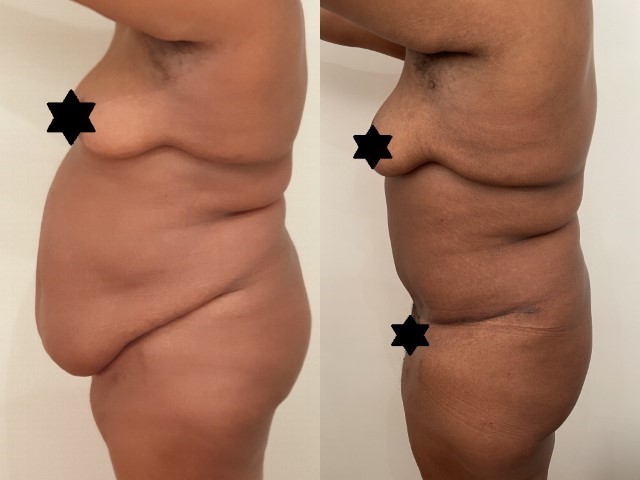 Abdominoplastie, cas 59, photographie avant et après