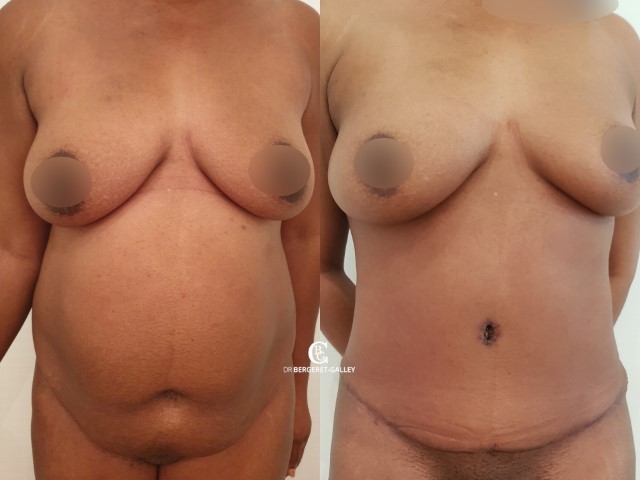 Abdominoplastie, cas 60, photographie avant et après